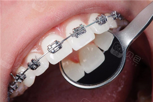 国产金属自锁托槽牙齿矫正展示