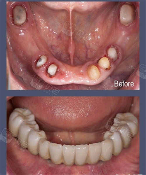 北京十佳口腔医院种植牙价格对比,北京种牙没那么贵!