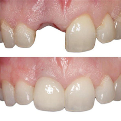门牙种植前后对比