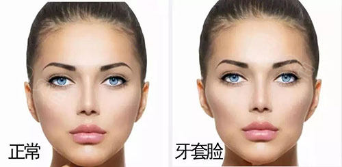 牙套脸对比