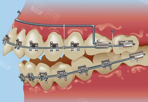 在普宁流沙做牙齿矫正哪家医院好一点 做过的朋友分享一下