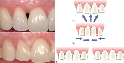 邻面去釉 正畸修复牙齿黑三角