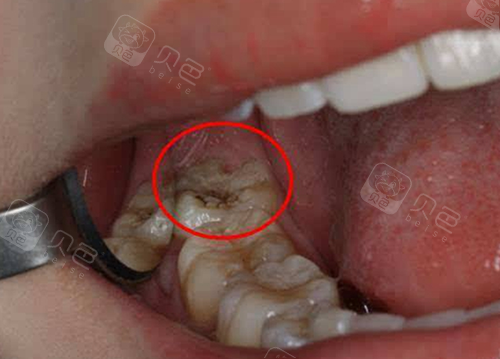 我想问下普宁补个牙和拔个智齿需要多少钱啊?