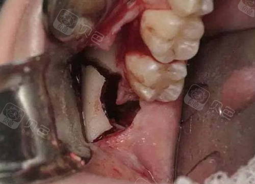 我想问下普宁补个牙和拔个智齿需要多少钱啊?