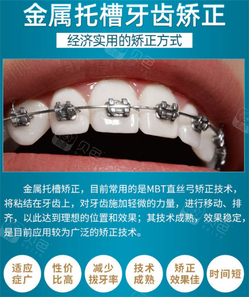 金属托槽矫正宣传图