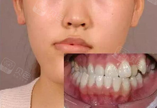 偏颌不治疗会越来越严重吗,偏颌不矫正会出现哪些后果?