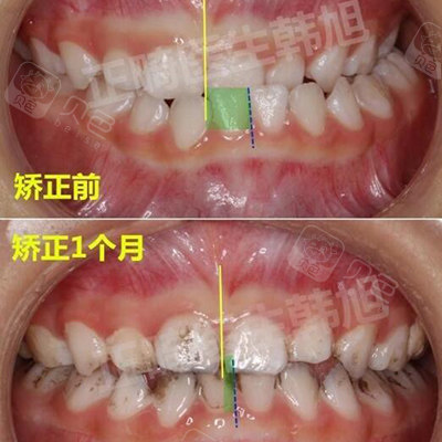 偏颌不治疗会越来越严重吗,偏颌不矫正会出现哪些后果?