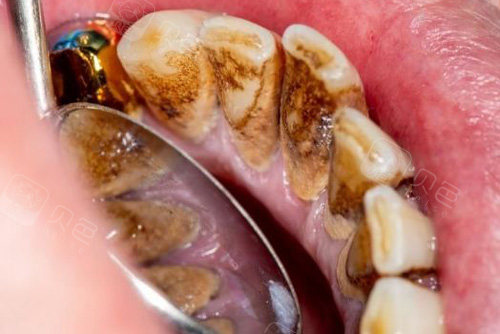 分析牙菌斑形成过程