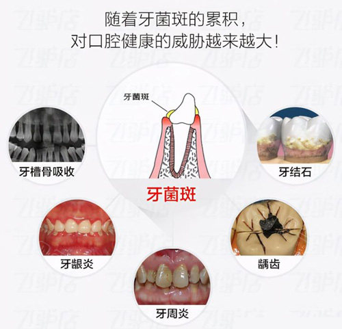 牙菌斑是怎么形成的如何给它去掉分析牙菌斑形成过程