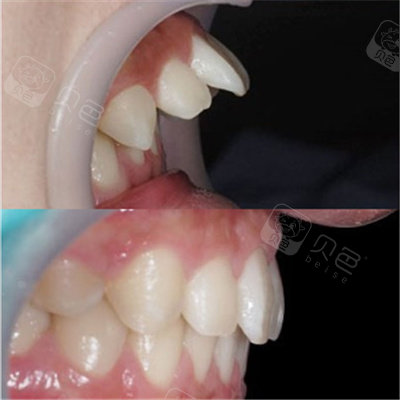 厦门戴牙套去哪个医院比较好?戴牙套一般要多少钱?