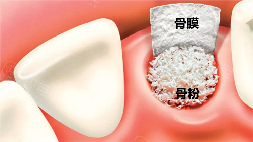 骨粉与骨膜示意图