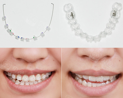 牙套要做贵的效果才好?来听听正规牙科怎么说!