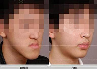 地包天月亮脸矫正前后对比