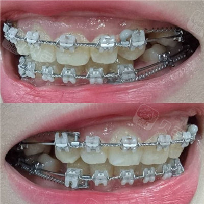 陶瓷半隐形托槽矫正器佩戴