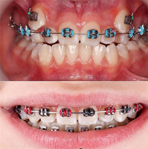 号外:太原哪个医院牙齿矫正比较好,本地人正畸通常选这几家