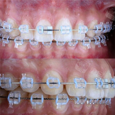 湘潭戴牙套要多少费用盘点湘潭能买到的牙套价格是多少