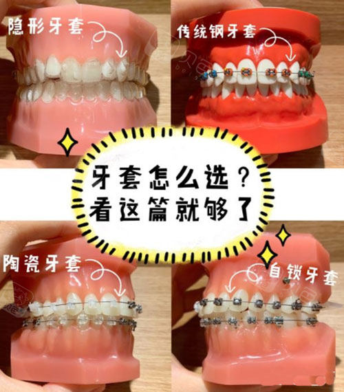 矫正牙套有几种及图片详解,六种矫正牙套的种类和价格分享!