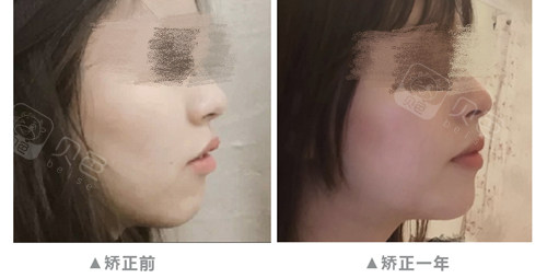 虎牙前突我到杭州美奥拔四颗牙带两年牙套后终于找回颜值!