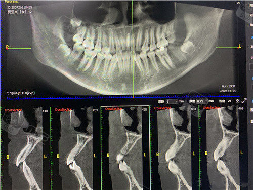 重庆正颌手术推荐医院盘点:这几家都是做牙齿矫正靠谱牙科!