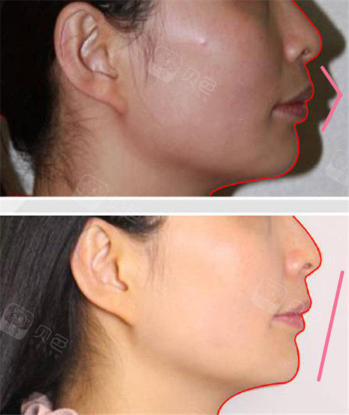 重庆正颌手术推荐医院盘点:这几家都是做牙齿矫正靠谱牙科!