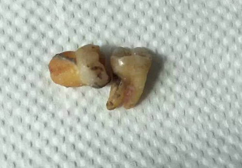 龋坏拔掉的牙齿照片