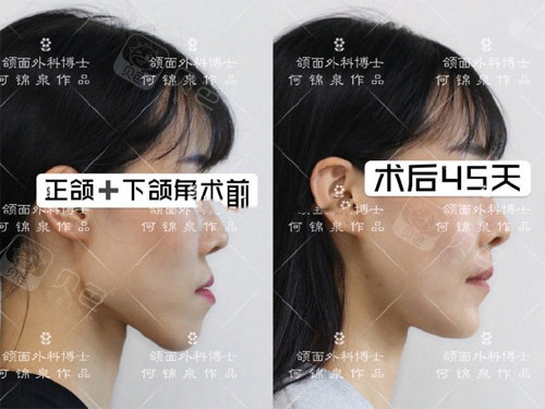 正颌前后对比展示图