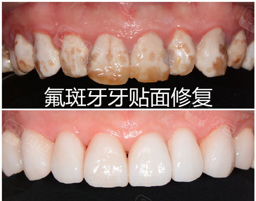 氟斑牙牙贴面修复对比