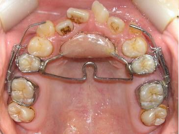 细数扩牙弓后对脸型的危害