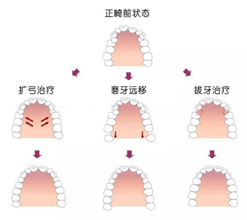 细数扩牙弓后对脸型的危害