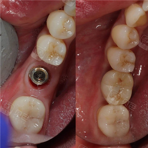 2021通辽口腔医院排名公布,牙齿种植与矫正技术到位口碑好!
