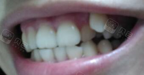 高位虎牙建议做牙齿矫正