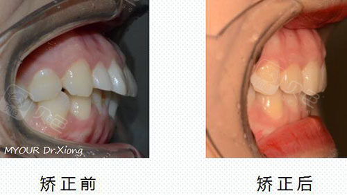 凸嘴矫正对比二:牙齿前突 开颌