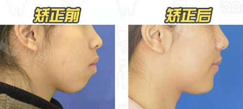 凸嘴矫正对比三:双颌牙齿前突 牙列不齐