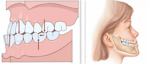 牙齿地包天怎么矫正多少钱,骨性牙性地包天纠正区别大吗?