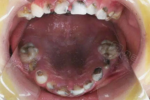 可以做全口种植牙吗?