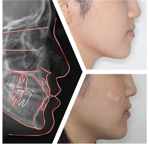 告诉您福州正颌手术医生哪个好!