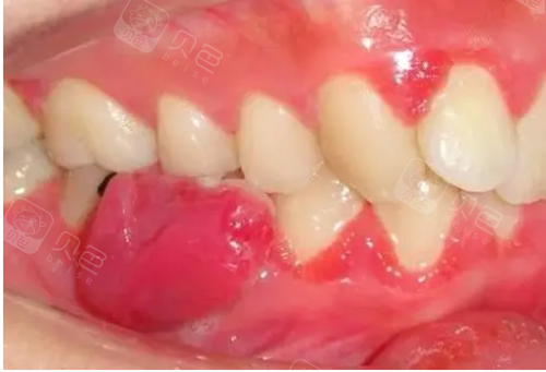 牙齿正在疼想直接去拔掉,牙医分析后再也不冲动了.