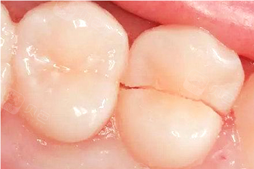 牙齿正在疼想直接去拔掉,牙医分析后再也不冲动了.