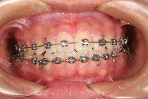 上海浦东矫正牙齿哪个医院好,这三家做正畸改善效果好!