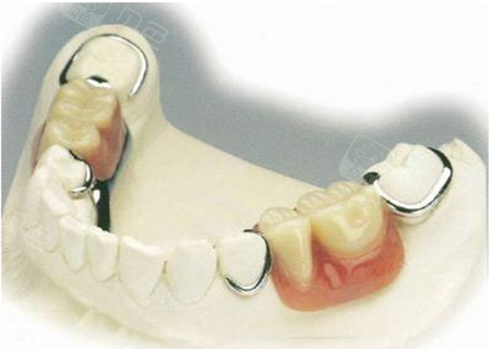 大牙坏了换个假牙,也不知道是不是贵一定就好!