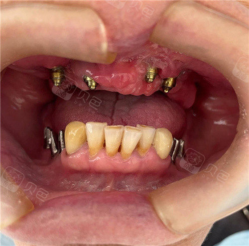 做种植牙在福州哪里做比较好?