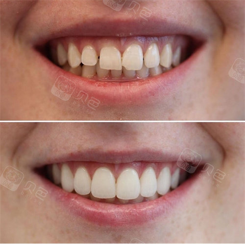 临沂微整美容口腔医院牙齿贴面对比