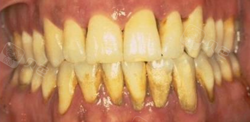 牙太黄了刷不干净想去做漂白,大概需要多少钱?