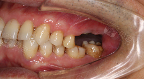 年轻人牙齿缺失一定要补吗