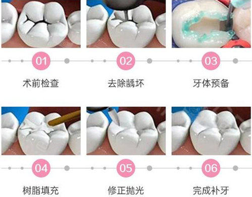 补一颗牙要多少钱?