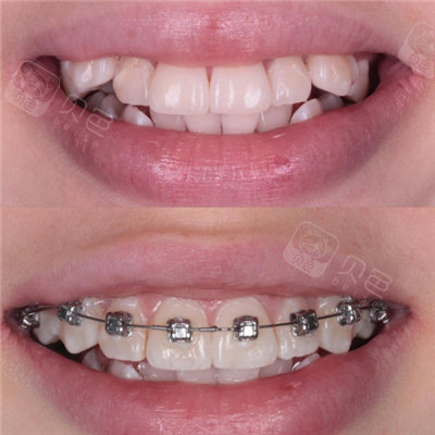 金属自锁牙套佩戴