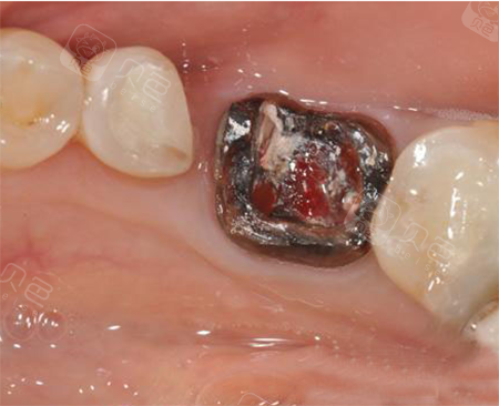 根管治疗后不做牙冠对还是错正规医生为你解释说明