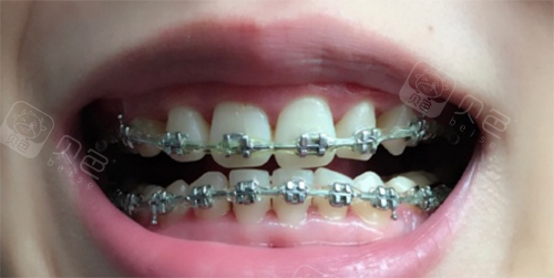 分享荆州牙齿矫正价格表,我是只花了6000元!