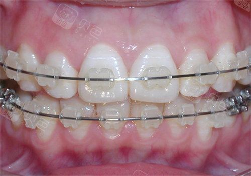 陶瓷自锁矫正器照片