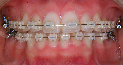 分享荆州牙齿矫正价格表,我是只花了6000元!